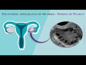 Pelvic ultrasound showing PCOS symptoms and polycystic ovaries used during diagnosis.