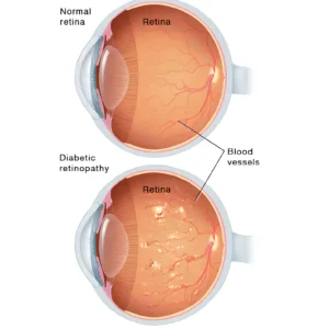 Diabetic retinopathy caused by diabetes mellitus complications affecting the retina
